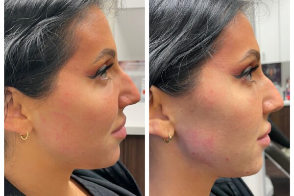 botox for jawline before and after natural slimming facial results