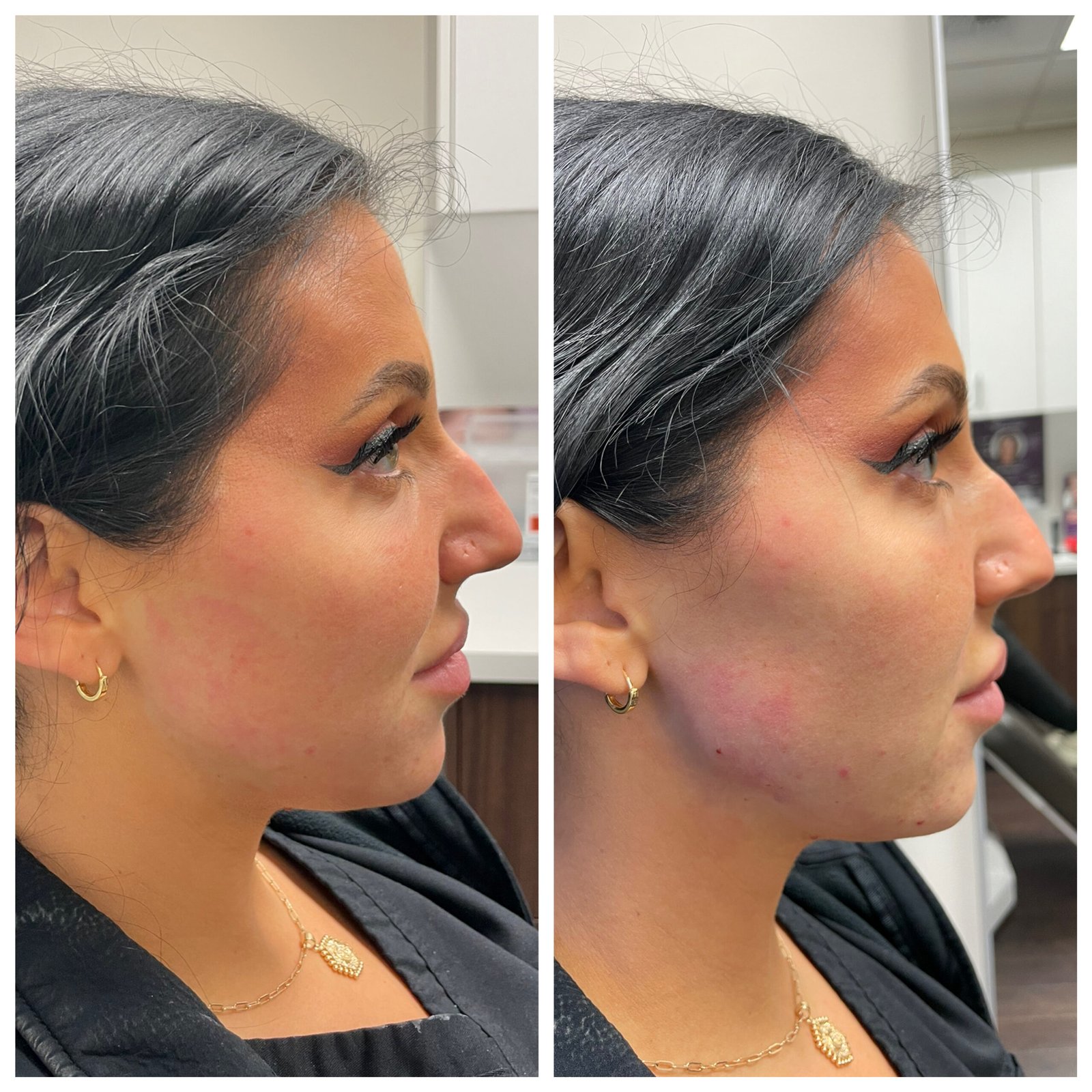 botox for jawline before and after natural slimming facial results