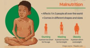 What Is Malnutrition