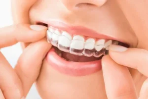 invisible aligners cost in india