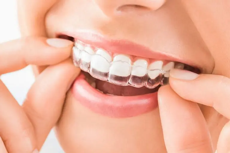 invisible aligners cost in india