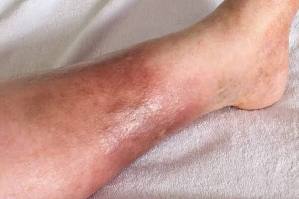 post thrombotic syndrome