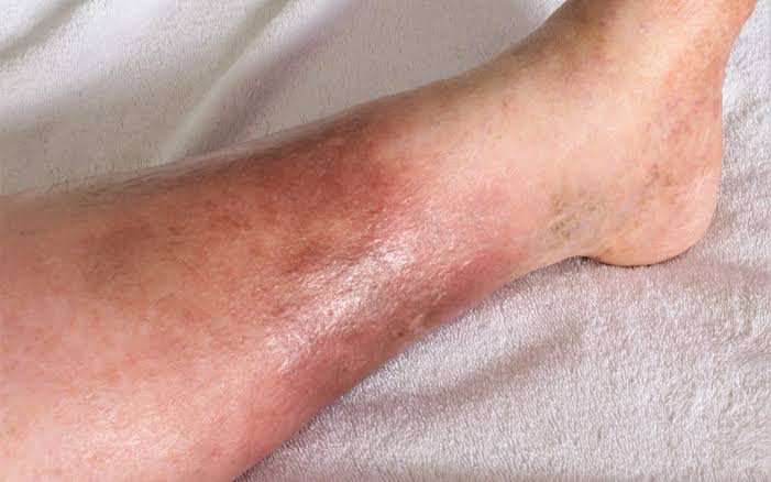 post thrombotic syndrome